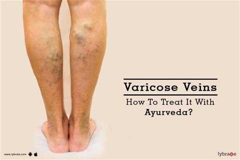 Herbs for Reducing Symptoms of Varicose Veins