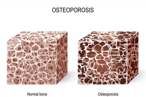 Herbs for Improving Bone Health and Reducing Osteoporosis